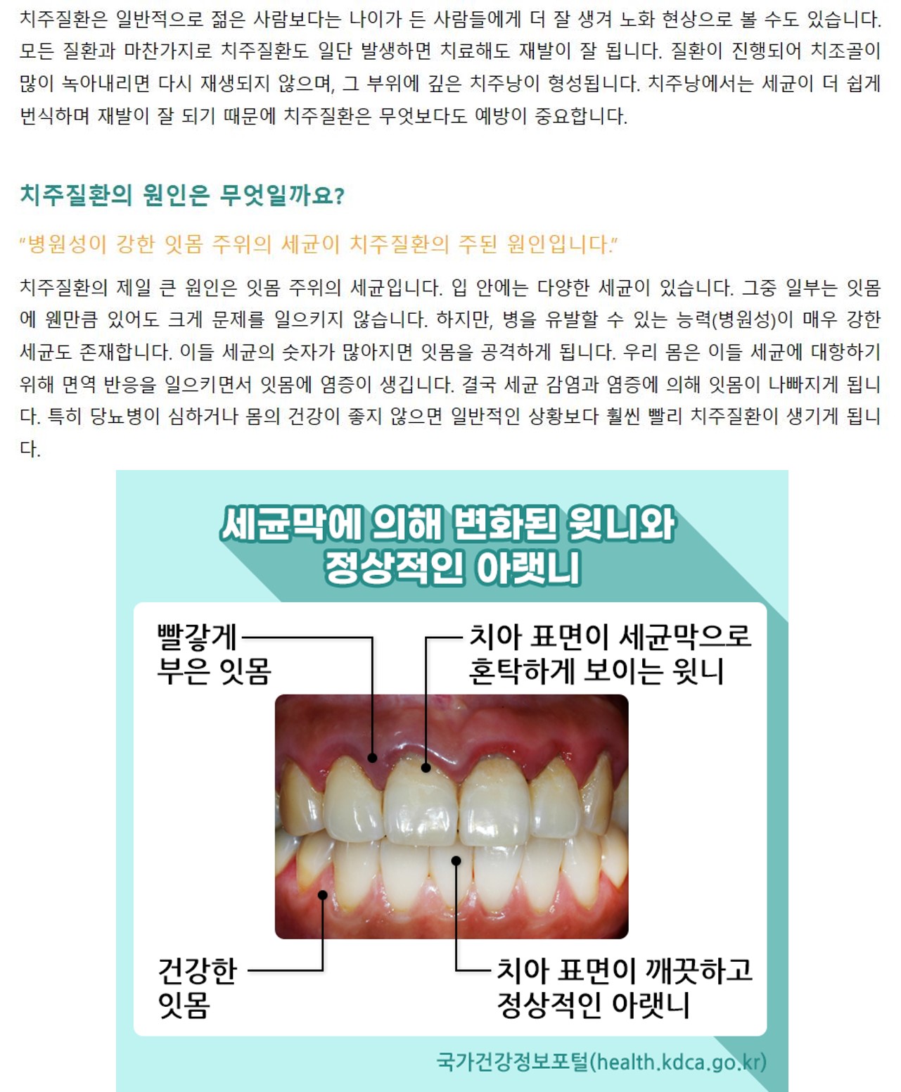 [스마일 구강]잇몸 건강, 꾸준한 관리가 필요합니다. 2