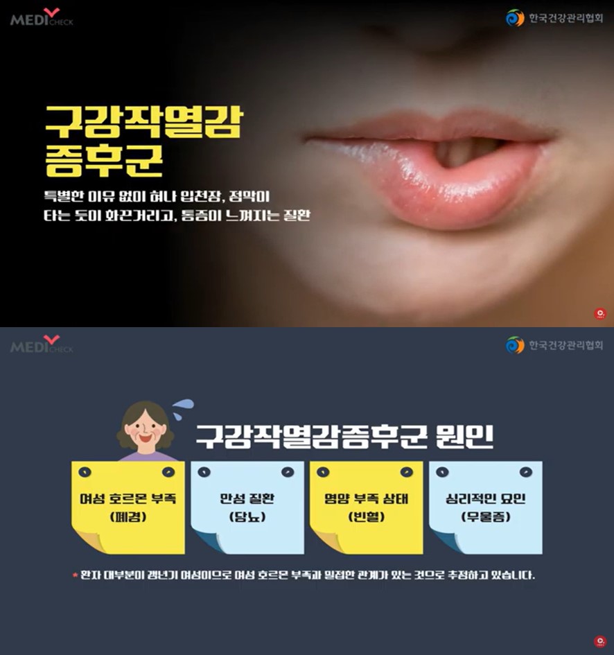 [스마일 구강]구강작열감증후군 갱년기 여성에게 흔합니다. 1