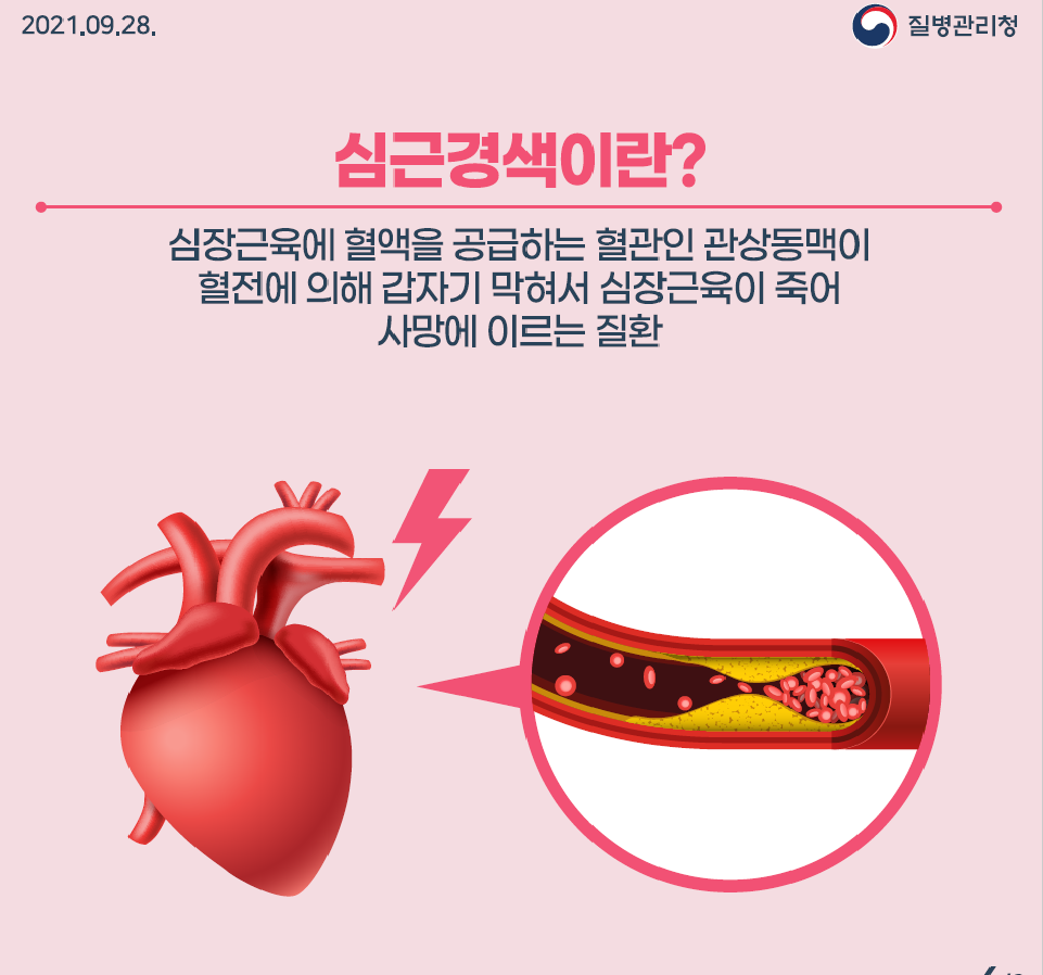 심근경색 한눈에 알아보기 2